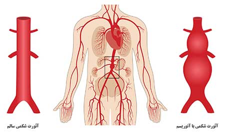جراحی عروق آنوریسم آئورت شکمی (AAA)