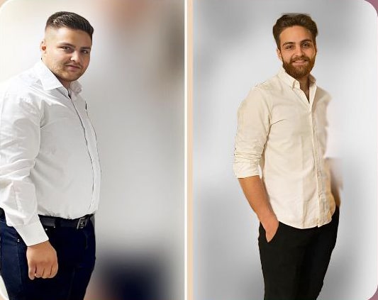 قبل و بعد جراحی چاقی توسط دکتر ناصر ملک پور