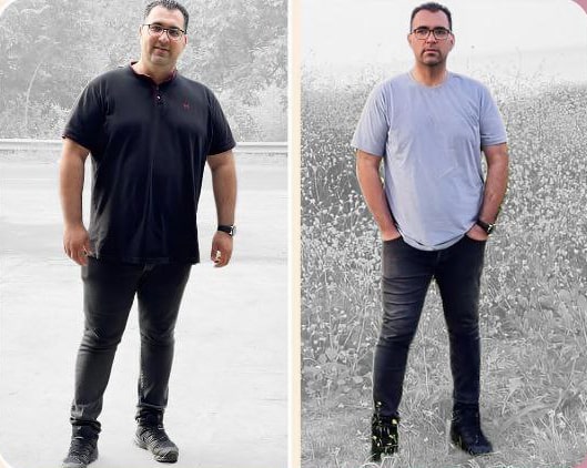 قبل و بعد واقعی جراحی لاغری توسط دکتر ناصر ملک پور