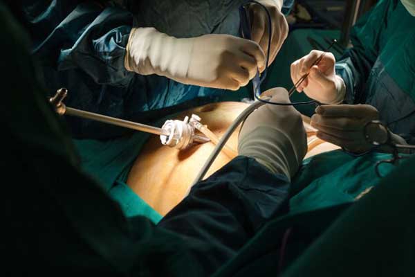 جراحی چاقی با لاپاراسکوپی