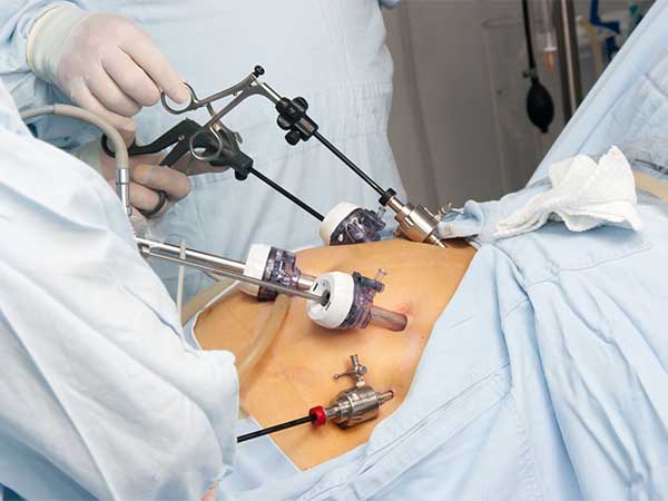 درمان چاقی مفرط با جراحی لاپاراسکوپی