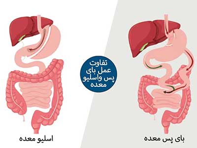 تفاوت جراحی اسلیو معده و بای پس معده