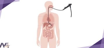 آندوسکوپی قبل از عمل اسلیو معده