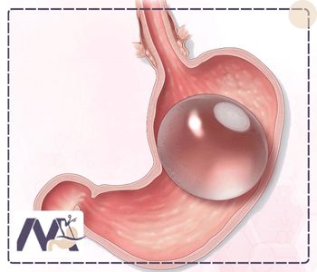 علائم ترکیدن بالن معده