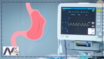 تپش قلب بعد از عمل اسلیو معده 