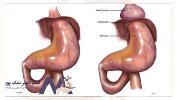 فتق هیاتال یا فتق معده