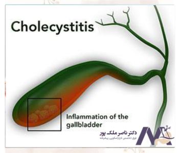 درمان کوله سیستیت حاد