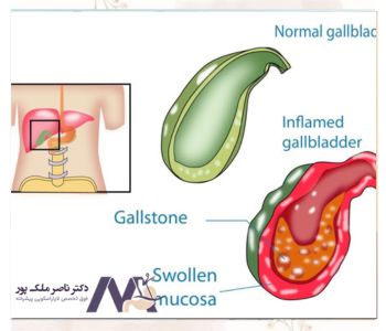 عوارض کله سیستیت