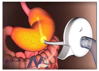 درن در جراحی اسلیو معده 