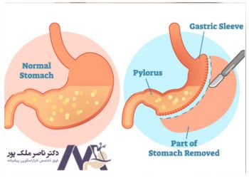 مقایسه بوتاکس معده و جراحی اسلیو معده