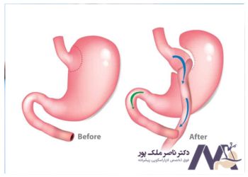 مقایسه عمل بای پس و مینی بای پس معده