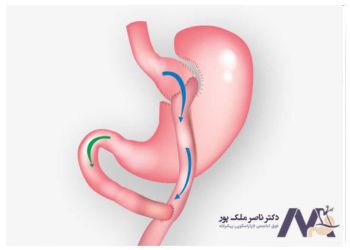 مقایسه عوارض مینی بای پس و بای پس معده