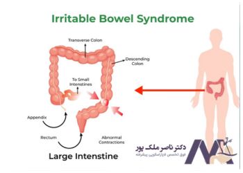 روده تحریک‌پذیر (IBS) 