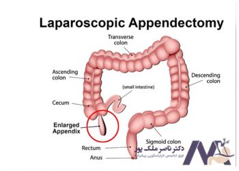 جراحی لاپاراسکوپی آپاندیس