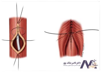 جراحی بستن رگ اشتها