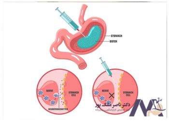 فرق جراحی اسلیو معده و بوتاکس معده