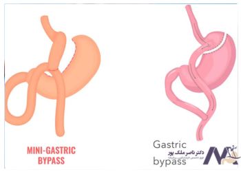 فرق مینی بای پس و بای پس معده از نظر جراحی