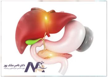 Complications-of-gallbladder-removal-perspective-of-traditional-medicine عوارض برداشتن کیسه صفرا از نظر طب سنتی