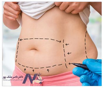 Localized-obesity-surgery جراحی چاقی موضعی