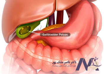 Photo-of-gallbladder-polyp عکس پولیپ کیسه صفرا