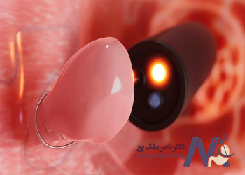 Symptoms-of-gallbladder-polyps علائم پولیپ کیسه صفرا