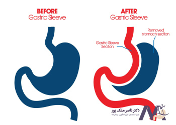 importance-of-diet-in-pregnancy-after-gastric-bypass اهمیت رژیم غذایی در بارداری بعد از بای پس معده