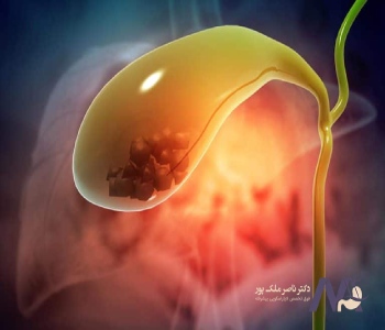 Causes of gallstones during pregnancy دلایل ایجاد سنگ کیسه صفرا در بارداری