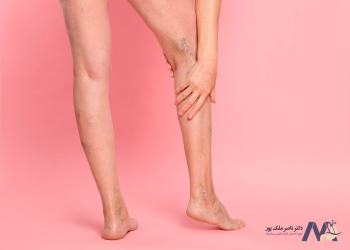 Causes-of-varicose-veins-in-women علل ایجاد واریس پا در زنان