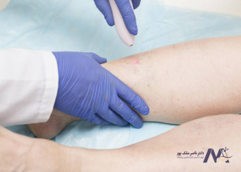 Comparison-of-open-varicose-vein-surgery-and-laser-in-terms-of-how-it-is-performed مقایسه جراحی باز واریس و لیزر از نظر نحوه انجام