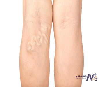 پیشگیری از ابتلا به واریس در اثر نشستن و ایستادن زیاد