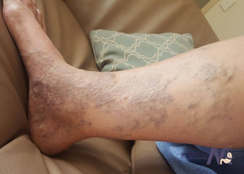 Prevention-of-varicose-veins-during-pregnancy پیشگیری از واریس بارداری