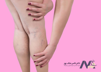 Symptoms-of-varicose-veins-in-women علائم واریس پا در زنان
