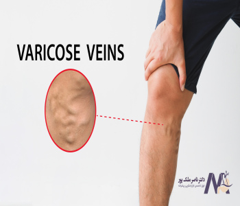 The-best-exercise-for-varicose-veins بهترین ورزش واریس پا