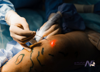 The-difference-between-open-varicose-vein-surgery-and-laser-in-terms-of-benefits فرق جراحی باز واریس و لیزر از نظر مزایا