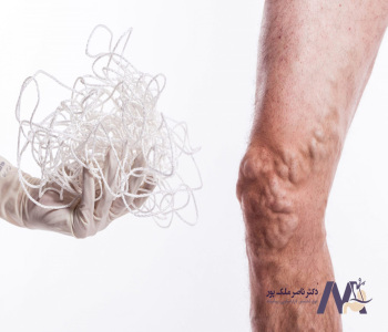 The-relationship-between-pulmonary-embolism-and-varicose-veins-in-elderly ارتباط آمبولی ریه و واریس در افراد مسن