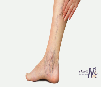 Treatment-of-varicose-veins-in-pregnancy درمان واریس پا در بارداری