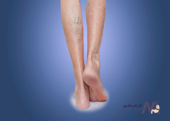Treatment-of-varicose-veins-in-women روش درمان واریس پا در زنان