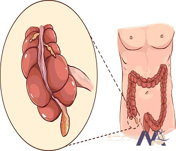 Complications-of-appendicitis pain_min عوارض درد آپاندیس