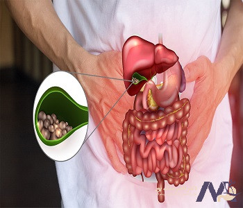 Gallstone-treatment-and-prevention درمان سنگ کیسه صفرا و پیشگیری از آن