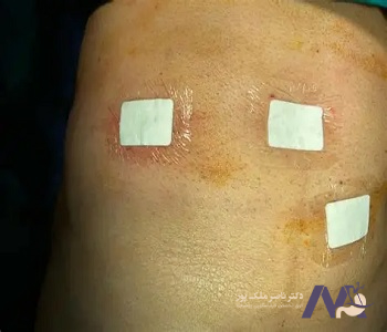 Post-surgery care for hernia with mesh-min مراقبت های بعد از عمل فتق با استفاده از مش