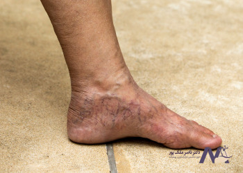 Prevention-of-varicose-veins پیشگیری از ابتلا به انواع واریس