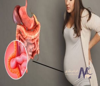 Symptoms of an umbilical hernia علائم فتق ناف