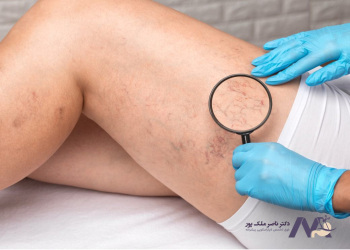 Symptoms-varicose-veins علائم واریس