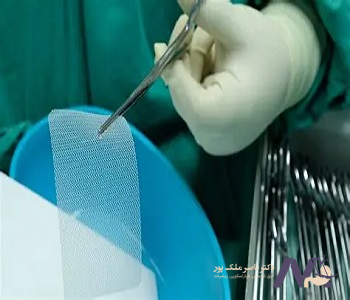 The best-type-of-mesh-for-hernia-surgery-min بهترین نوع مش برای جراحی فتق