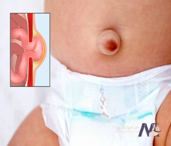 Umbilical hernia in children and adults فتق ناف در کودکان و بزرگسالان