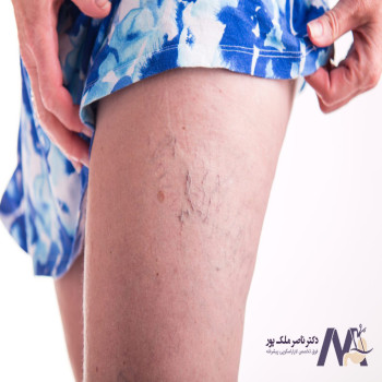 cause-of-varicose-veins علت بروز واریس