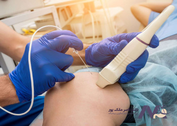 مزایای درمان واریس با لیزر rf