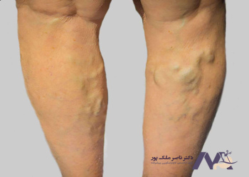 Cause-of-cord-varicose-veins علت واریس طنابی