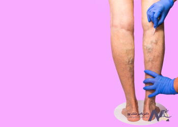 Characteristics-varicose-vein-specialist-in-Tehran ویژگی های متخصص واریس در تهران