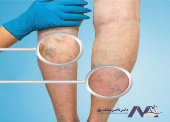 Complications-of-cord-varicose-veins عوارض واریس طنابی